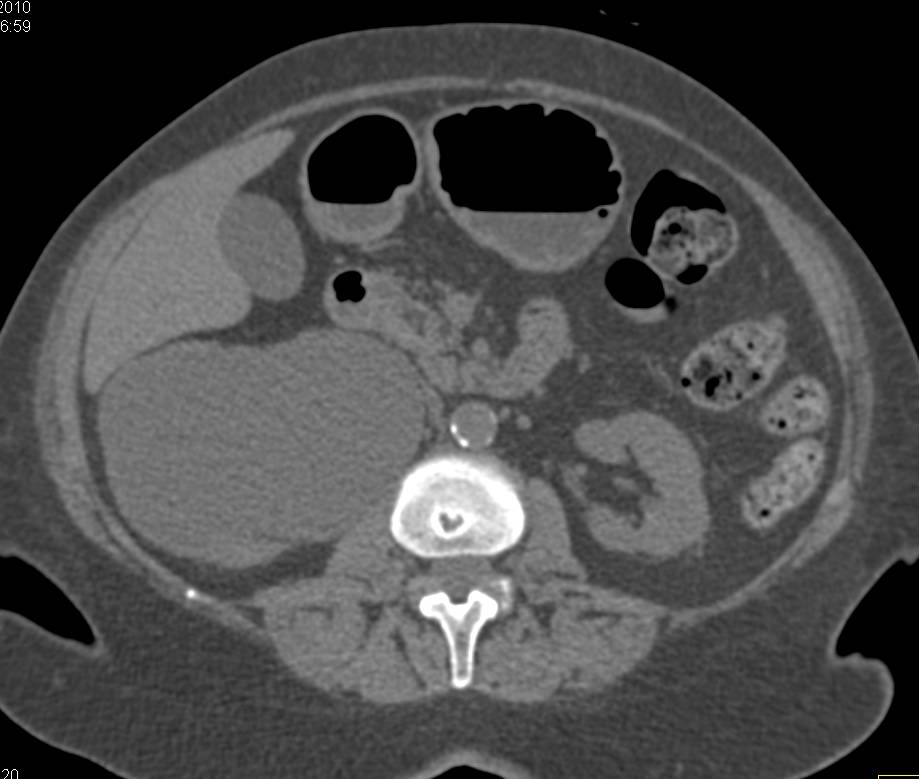 Transitional Cell Carcinoma of the Right Ureter Obstructing the Right Kidney - CTisus CT Scan