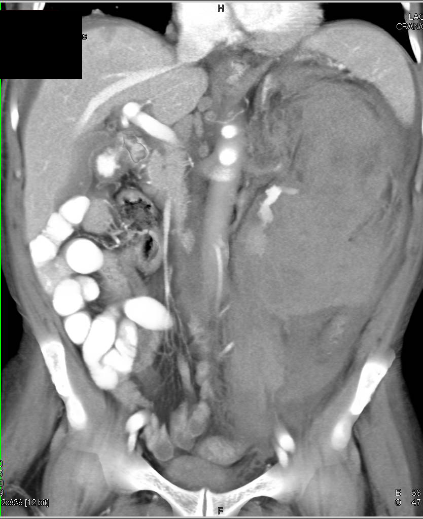 Active Bleed from a Renal Cell Carcinoma with a Perirenal Hematoma - CTisus CT Scan