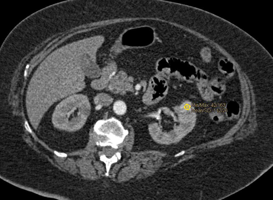 2 cm Renal Cell Carcinoma - CTisus CT Scan