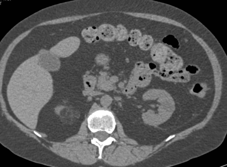 Right Renal Angiomyelolipoma - CTisus CT Scan