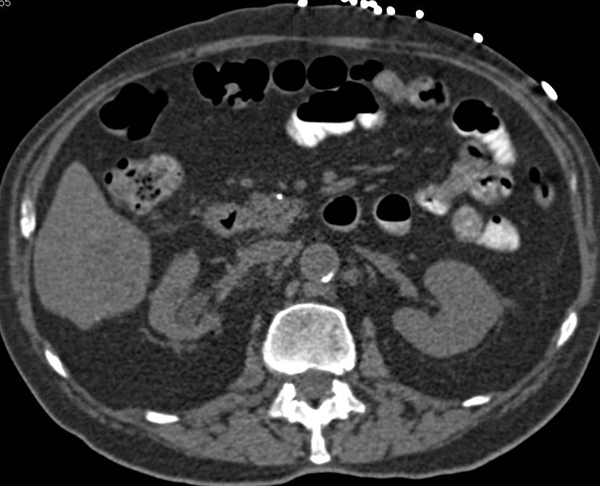 Transitional Cell Carcinoma of the Right Ureter with Inferior Vena Cava (IVC) Clot and Liver Metastases - CTisus CT Scan