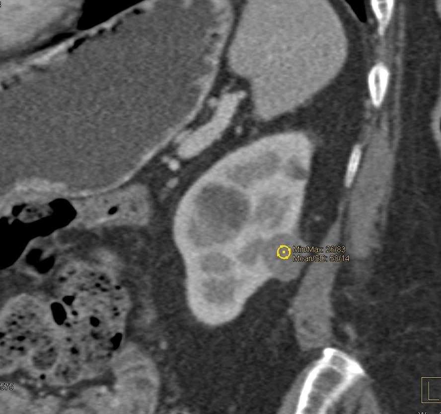 High Density Renal Cyst - CTisus CT Scan