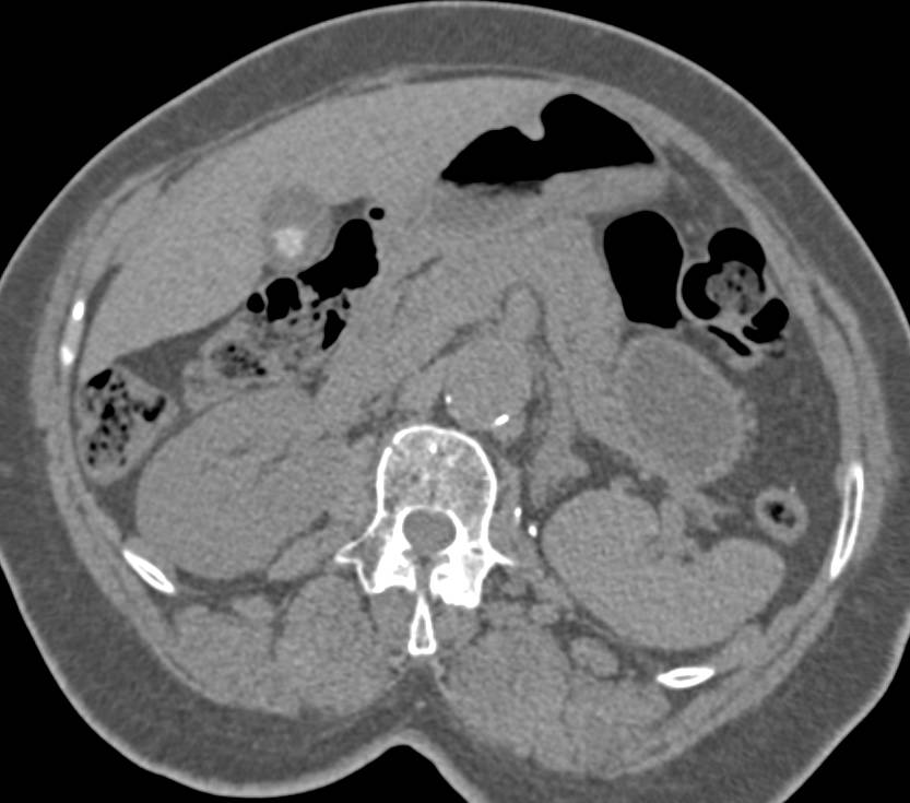 Normal Left Nephrectomy Bed - CTisus CT Scan