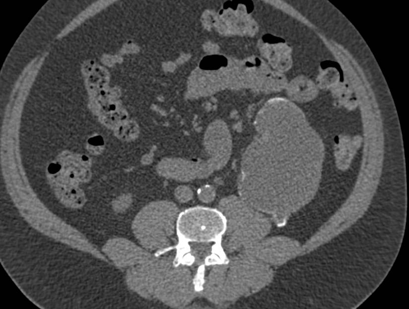 Cystic Renal Cell Carcinoma - CTisus CT Scan