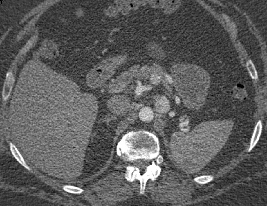 Recurrent Renal Cell Carcinoma Metastatic to the Lymph Nodes and the Pancreas - CTisus CT Scan