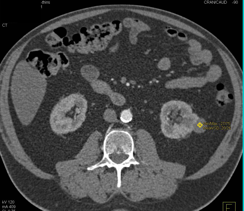 Low Grade Renal Cell Carcinoma - CTisus CT Scan