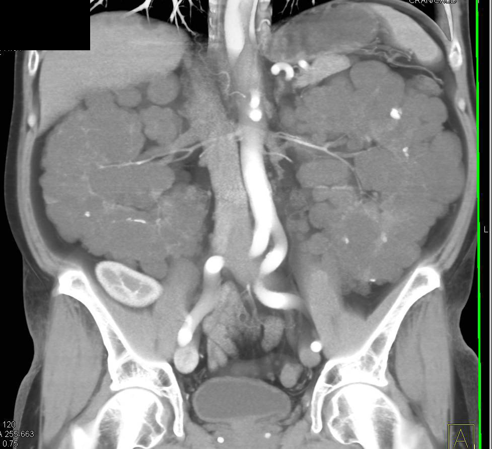 Polycystic Kidney Disease with a Renal Transplant - CTisus CT Scan