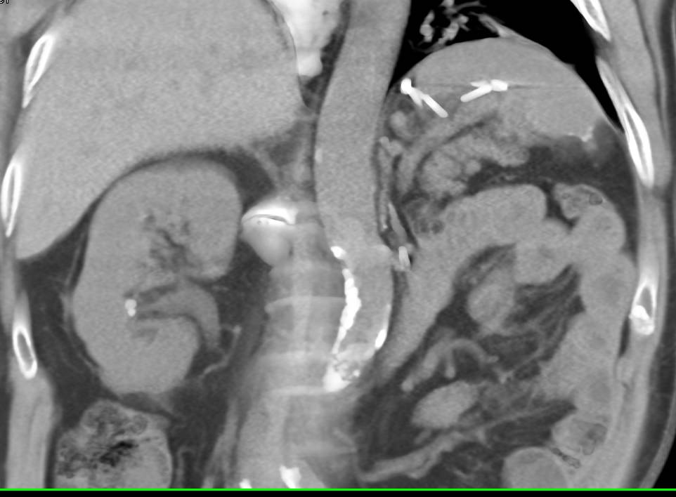 Normal Left Nephrectomy Bed and Incidental Hepatic Hemangioma - CTisus CT Scan