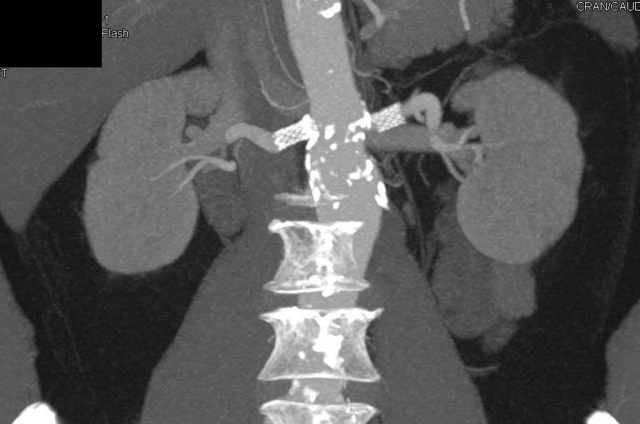 Patent Stents in the Proximal Renal Arteries - CTisus CT Scan