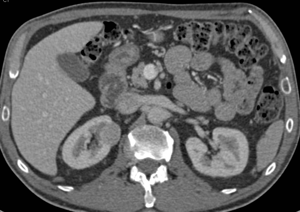 2 Cm Right Papillary Renal Cell Carcinoma - CTisus CT Scan