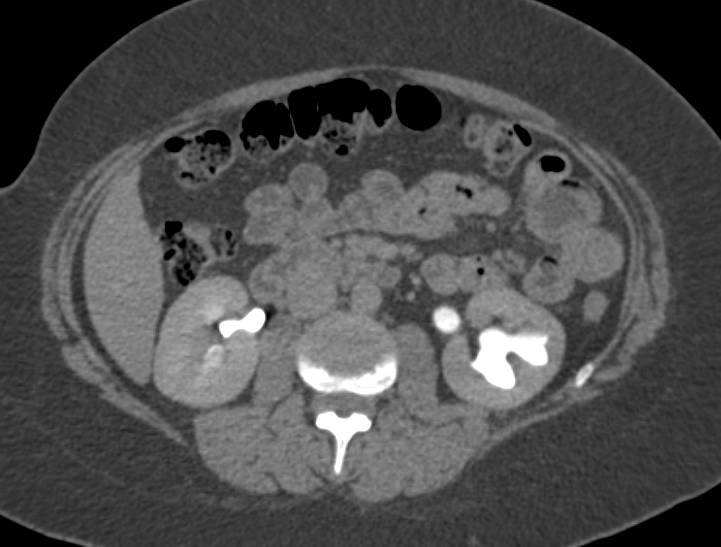 Transitional Cell Carcinoma Distal Left Ureter on CT Urogram - CTisus CT Scan