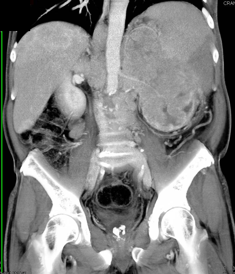 Renal Cell Carcinoma with Adenopathy, Liver Metastases and Splenic Metastases - CTisus CT Scan