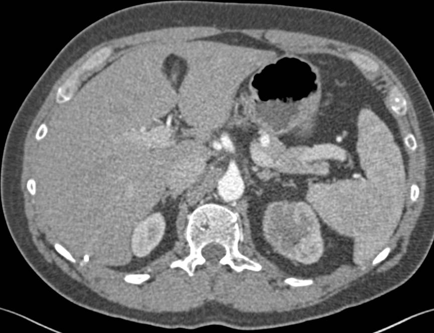 Transitional Cell Carcinoma Upper Pole of Left Kidney is Easy to Miss - CTisus CT Scan