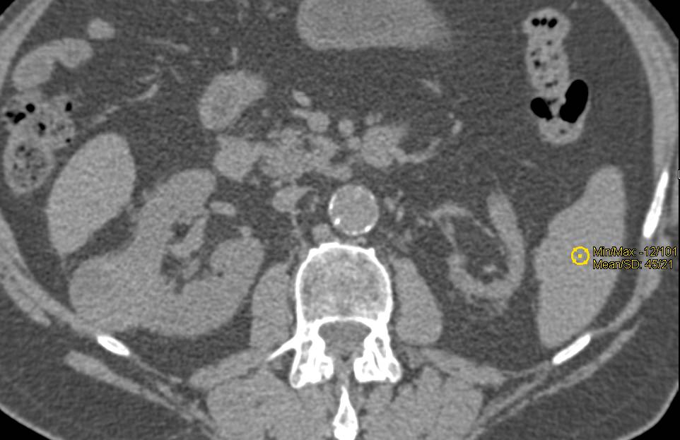 3 cm Papillary Renal Cell Carcinoma - CTisus CT Scan