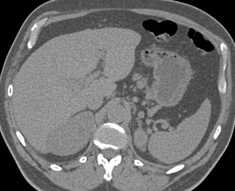 Recurrent Renal Cell Carcinoma Metastatic to the Contralateral Kidney and the Ipsilateral Adrenal Gland - CTisus CT Scan