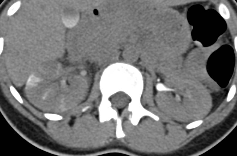 Acute Pyelonephritis Right Kidney in Various Displays - CTisus CT Scan