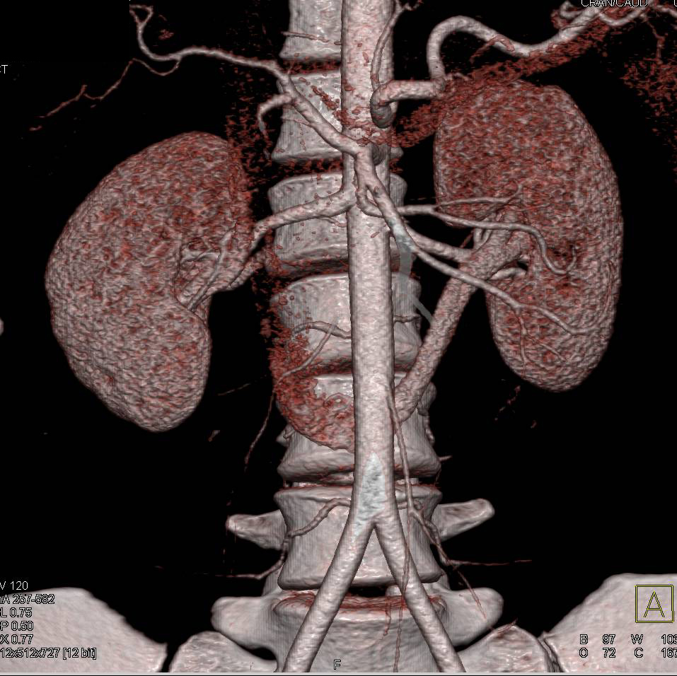 Retroaortic Left Renal Vein in a Potential Renal Donor - CTisus CT Scan