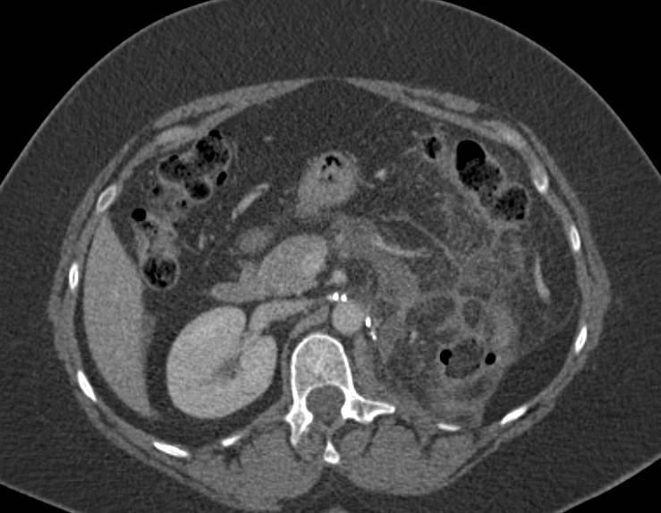 Sarcoma of the Capsule of the Left Kidney with Subsequent Recurrence - CTisus CT Scan