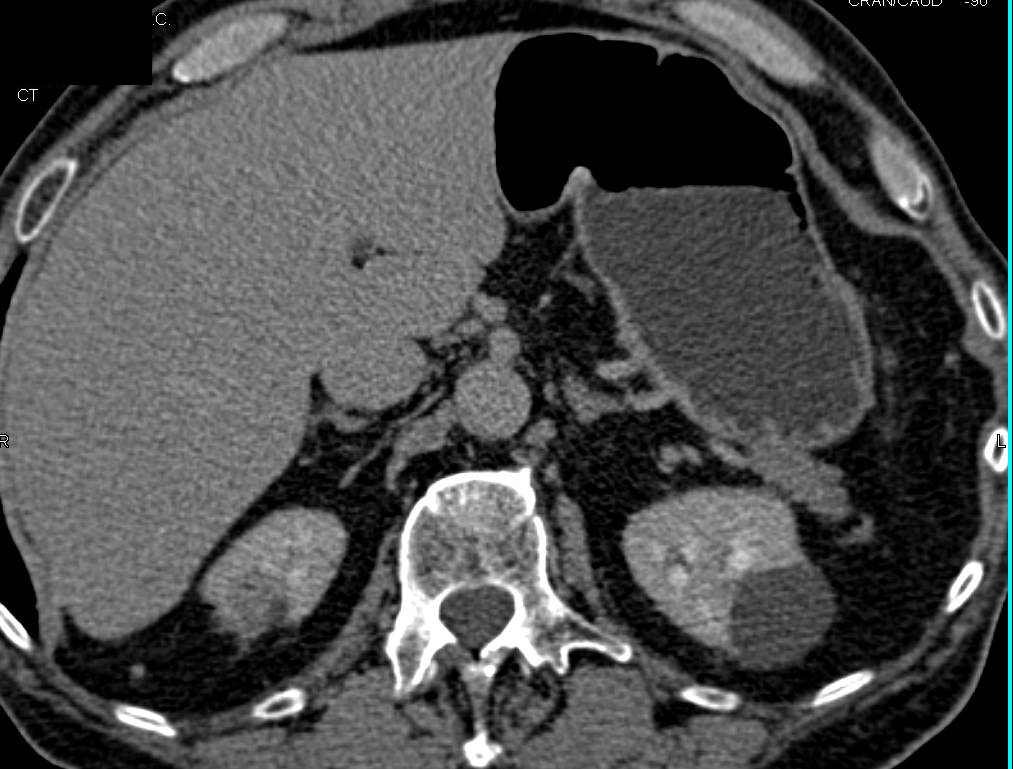 Prior Ablation of the Upper Pole of the Right Kidney - CTisus CT Scan