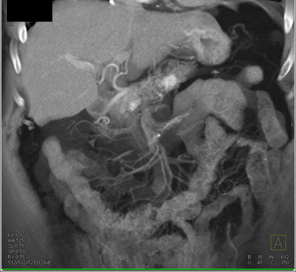 Recurrent Renal Cell Carcinoma Metastatic to the Contralateral Kidney and the Pancreas - CTisus CT Scan