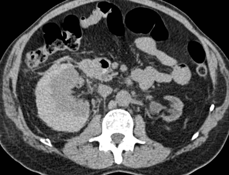 Right Perirenal Bleed s/p Biopsy - CTisus CT Scan