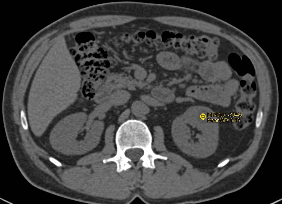 High Density Renal Cysts - CTisus CT Scan