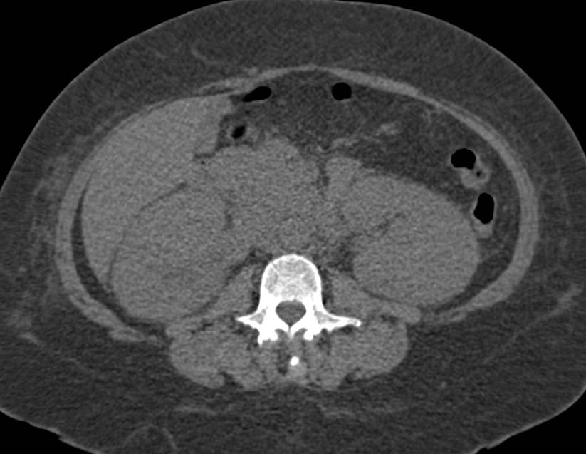 Acute Pyelonephritis in Multiple Phases - CTisus CT Scan