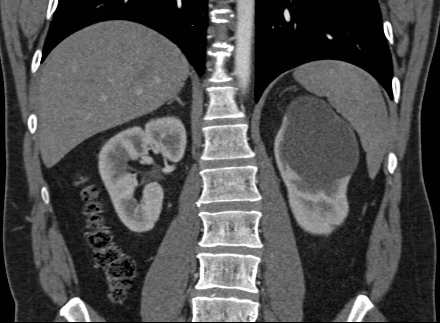 Bosniak II Cyst - Kidney Case Studies - CTisus CT Scanning