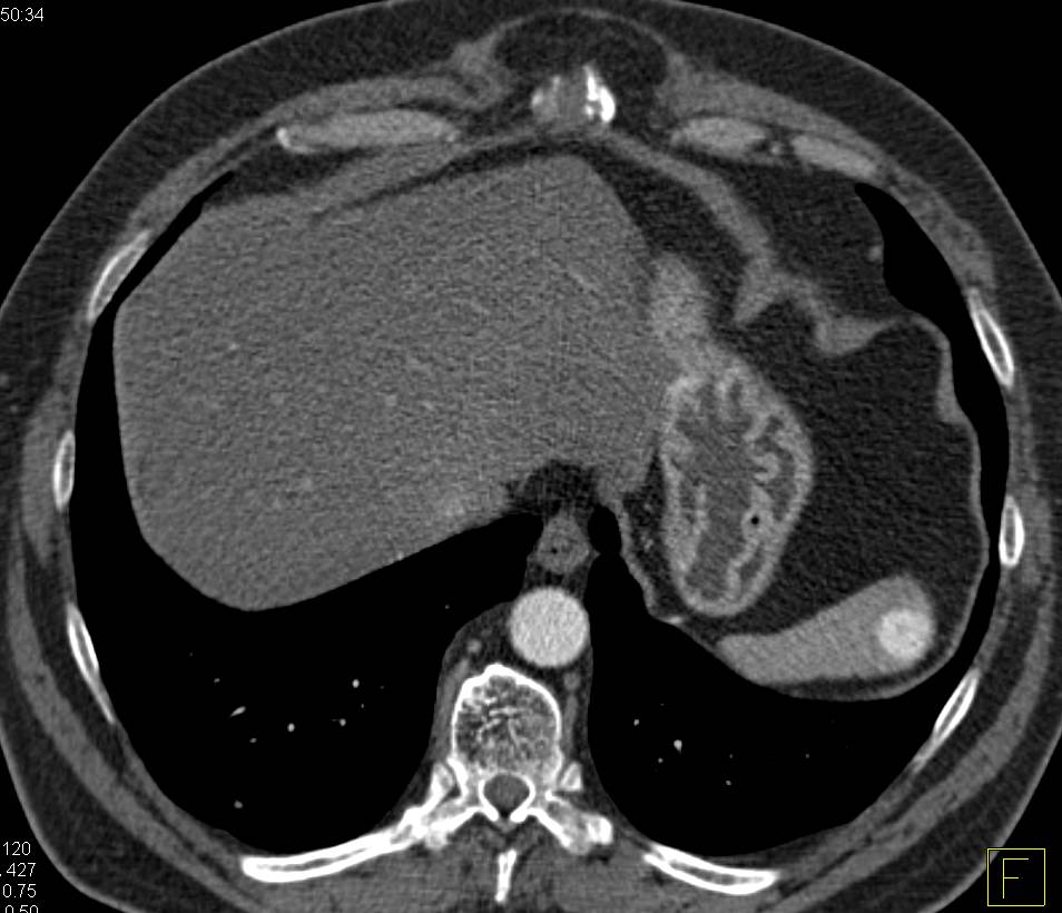 Renal Cell Carcinoma Metastatic to the Spleen - CTisus CT Scan