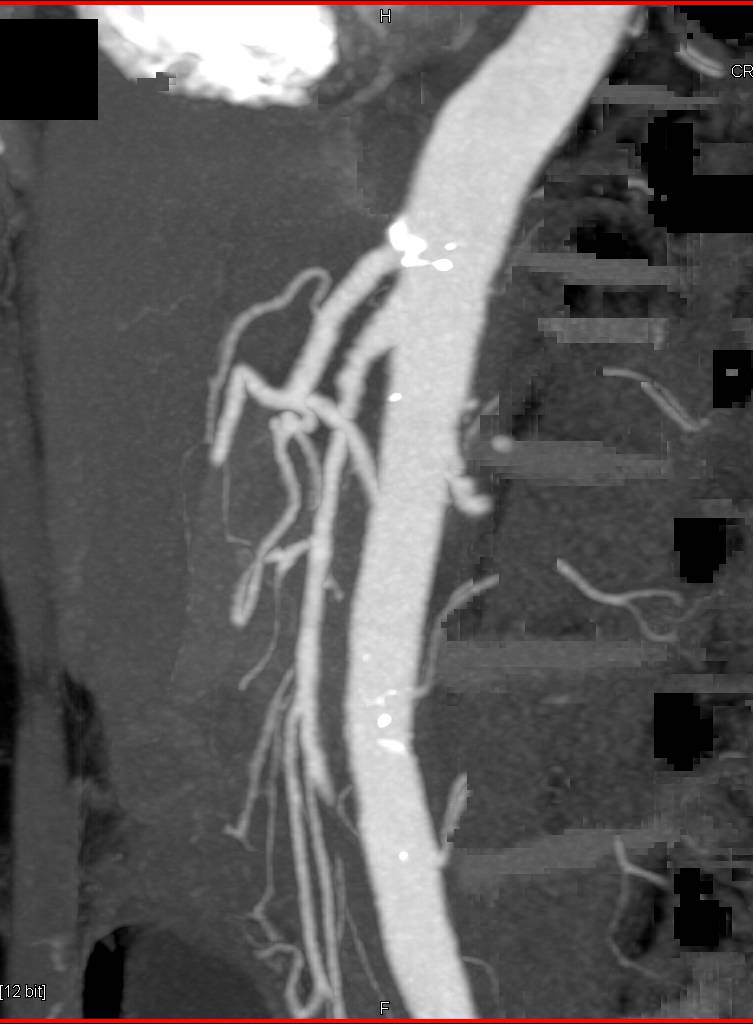 Bilateral Renal Artery Aneurysms - CTisus CT Scan