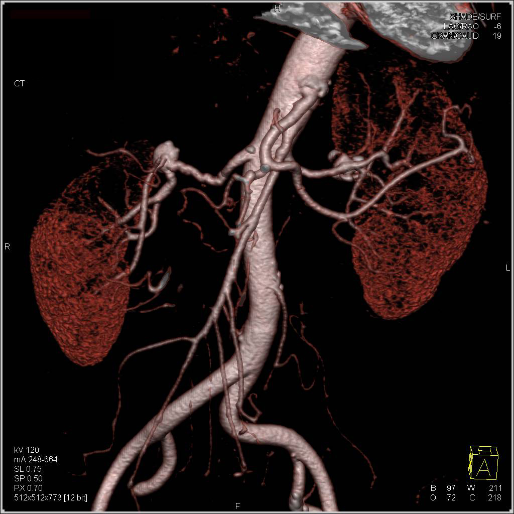 Bilateral Renal Artery Aneurysms - Kidney Case Studies - CTisus CT Scanning