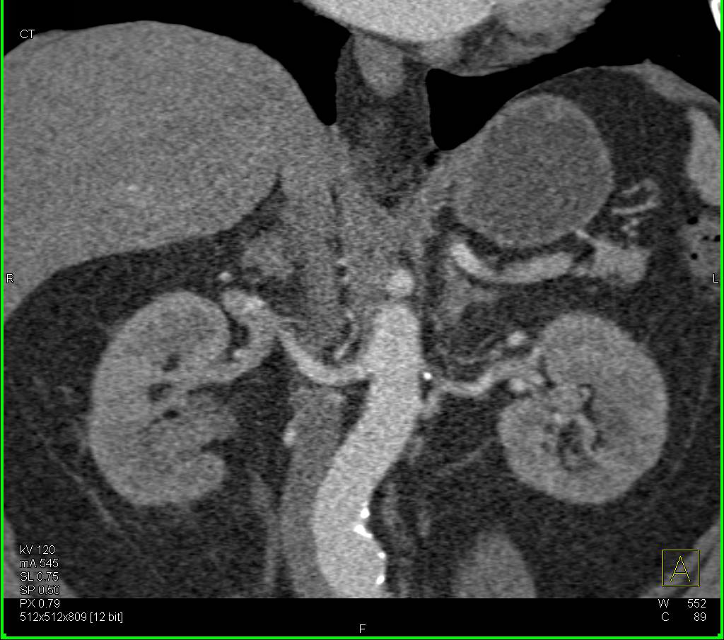 Medullary Sponge Kidneys seen on CT Urography - CTisus CT Scan