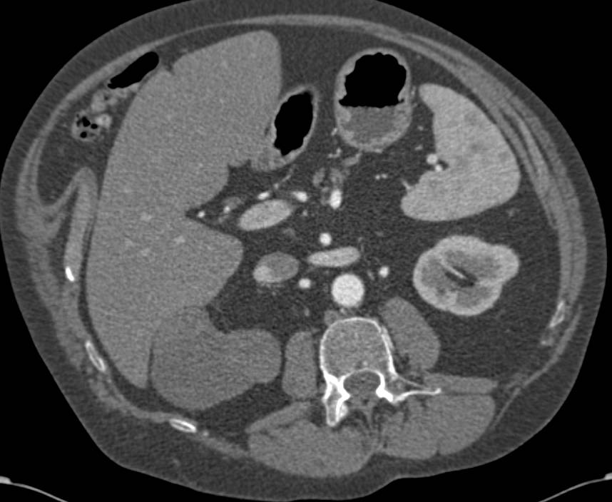 Lymphangioma Abuts the Right Kidney - CTisus CT Scan