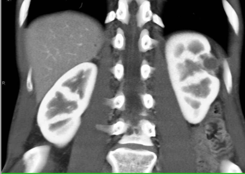 Prior Cryoablation Site - CTisus CT Scan