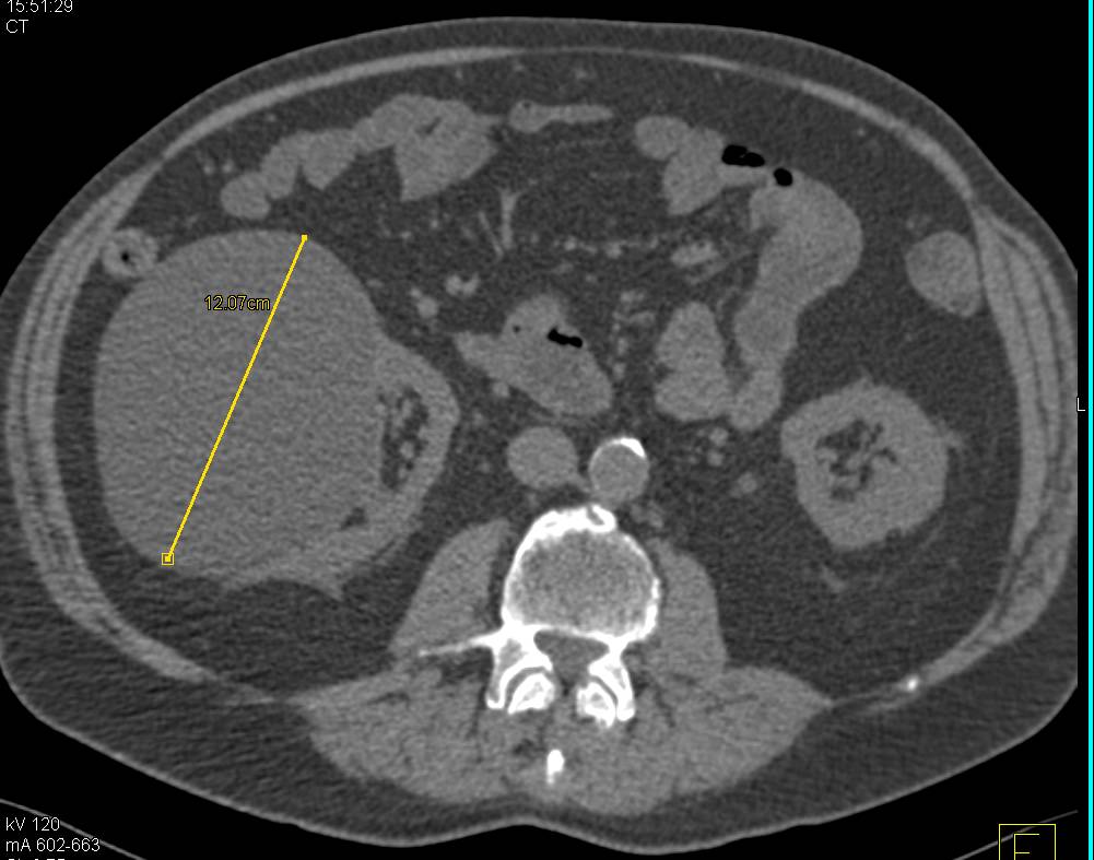 Multiphase Imaging of the Kidney with a Solid Nodule Seen in A Renal Cyst. The Nodule was Malignant. - CTisus CT Scan