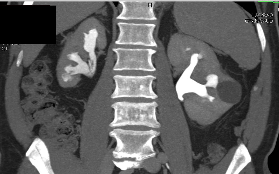 Chronic Pyelonephritis Right Kidney with Multiple Filling Defects Representing Blood Clots - CTisus CT Scan