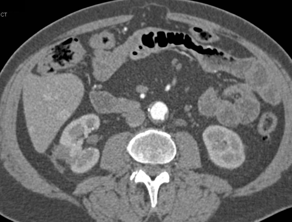 Recurrent Renal Cell Carcinoma Metastatic to the Liver with Vascular Metastases - CTisus CT Scan