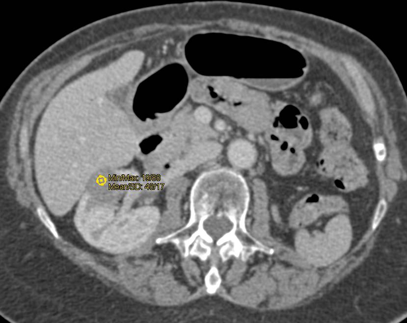 High Density Renal Cyst - CTisus CT Scan