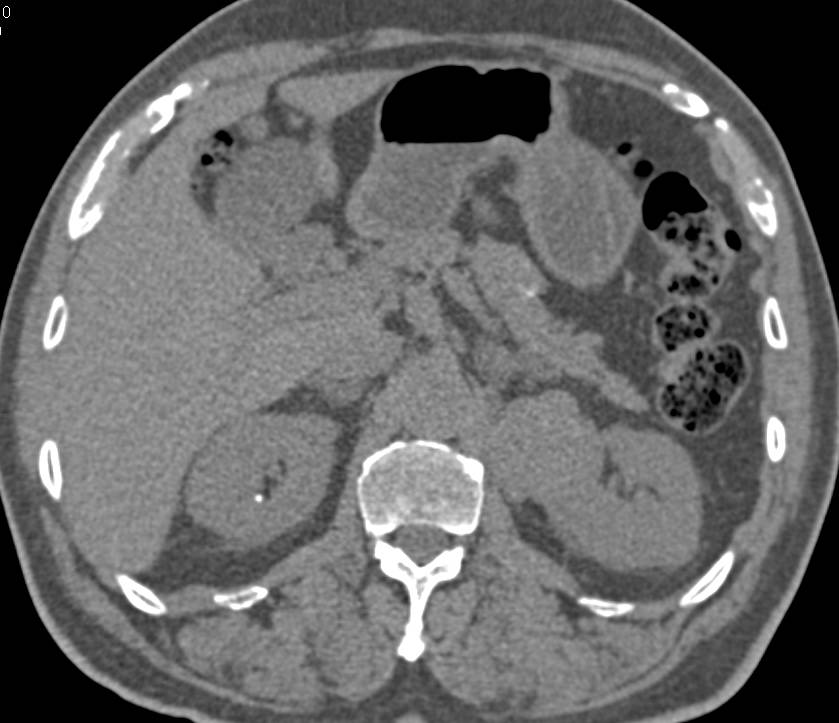 Renal Cell Carcinoma - CTisus CT Scan