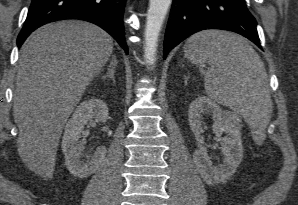 Subtle Left Renal Cell Carcinoma - CTisus CT Scan