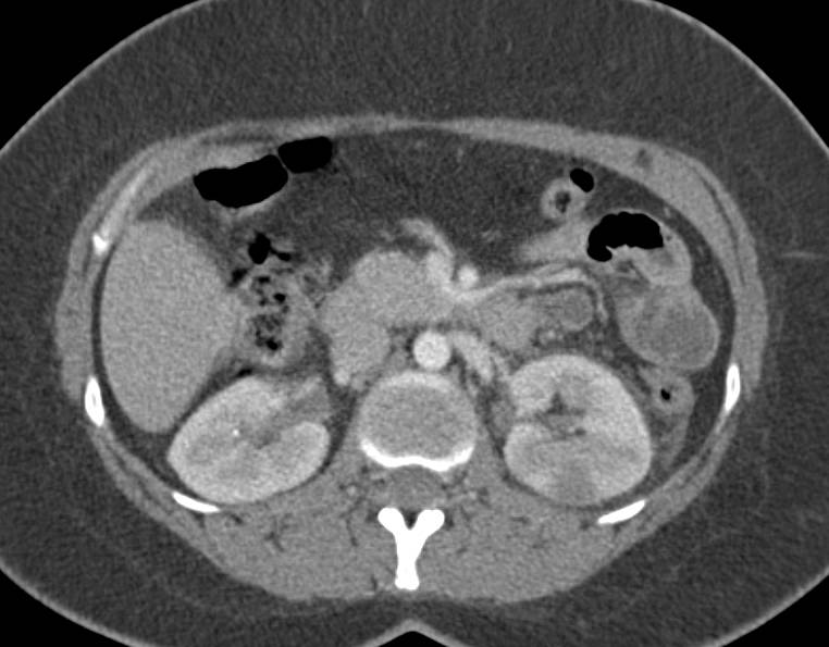 Acute Pyelonephritis with Patchy Nephrogram - CTisus CT Scan