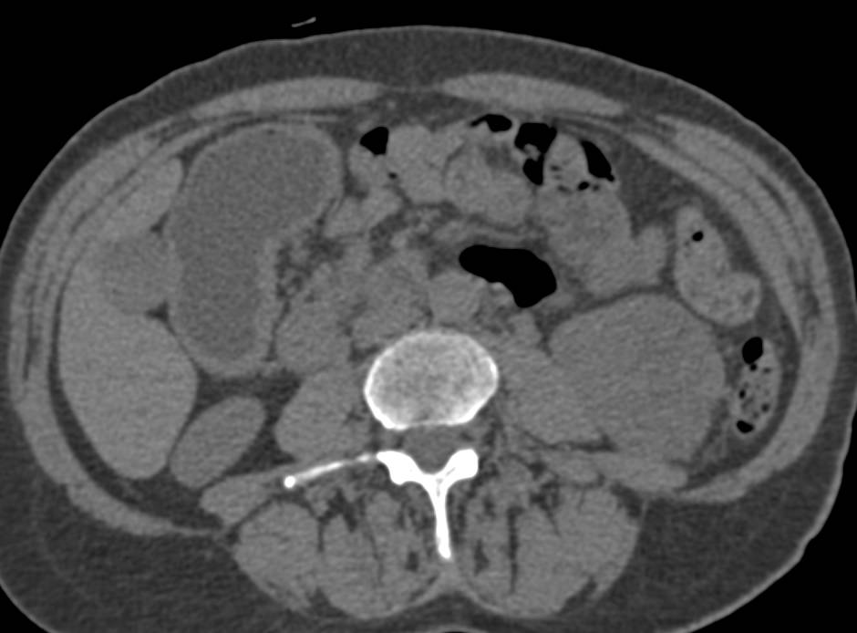 Cystic Renal Cell Carcinoma which looks a bit like an Oncocytoma - CTisus CT Scan