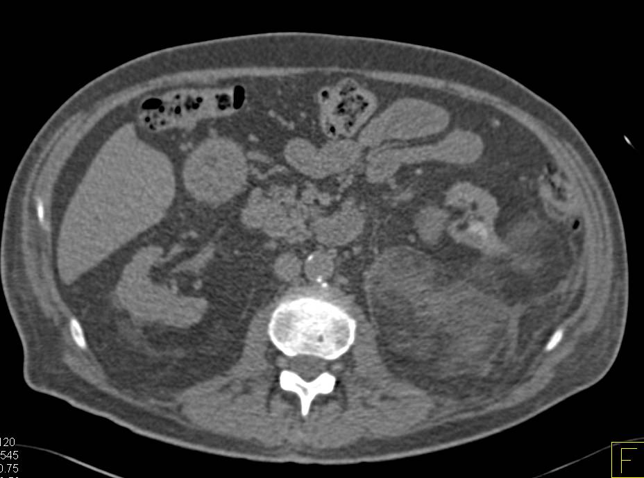 Left Renal Angiomyolipoma with Bleed - CTisus CT Scan