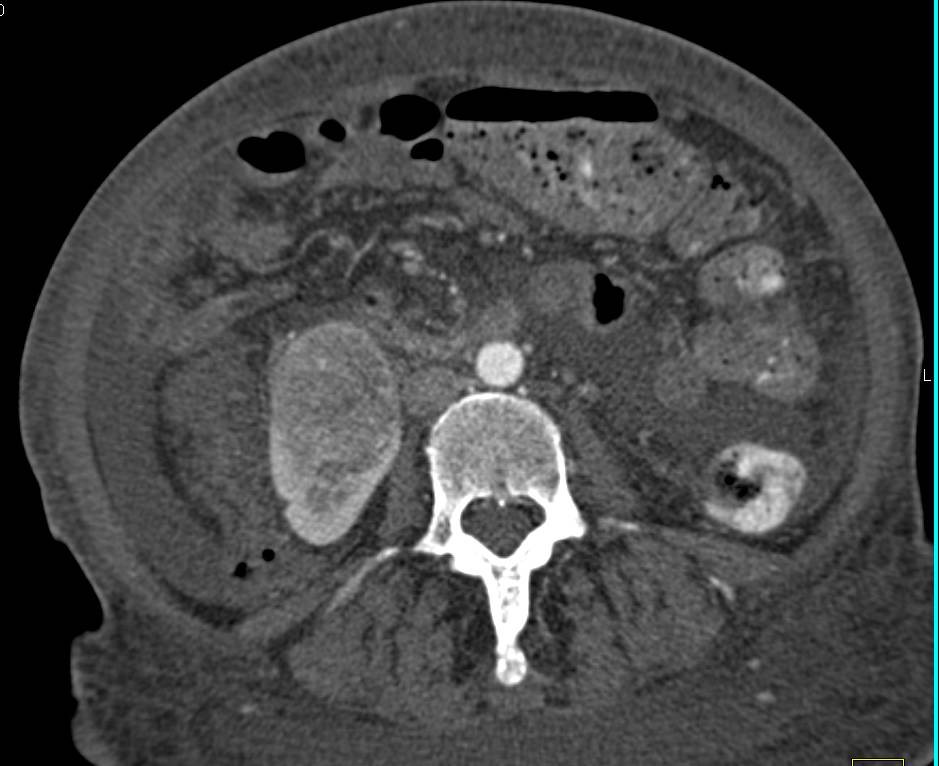 Renal Cell Carcinoma with Liver Metastases and Carcinomatosis - CTisus CT Scan