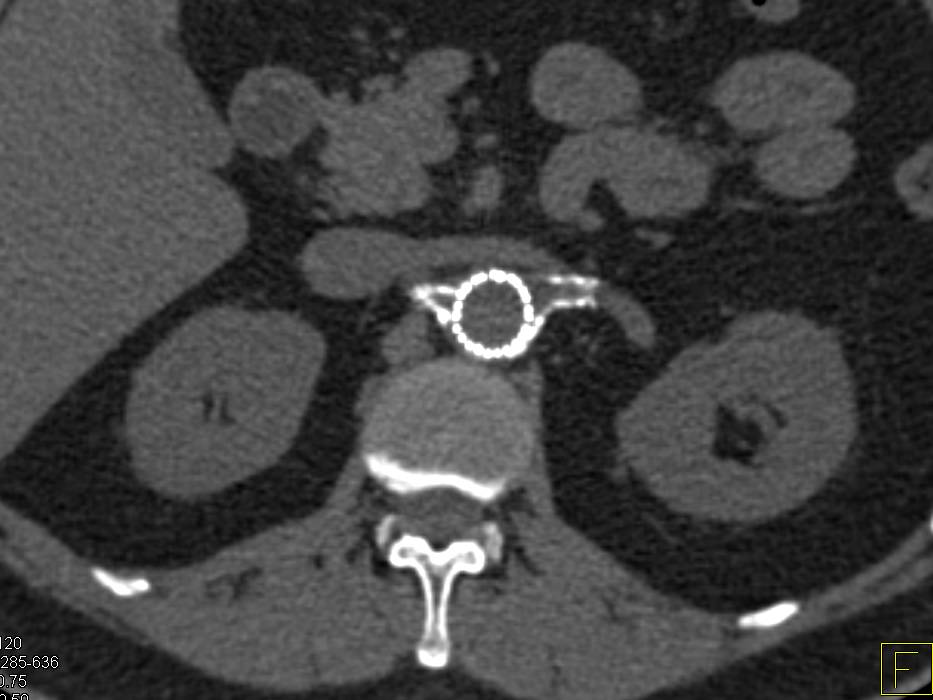 Endovascular Stent in the Abdominal Aorta with Stents in both Renal Arteries - CTisus CT Scan