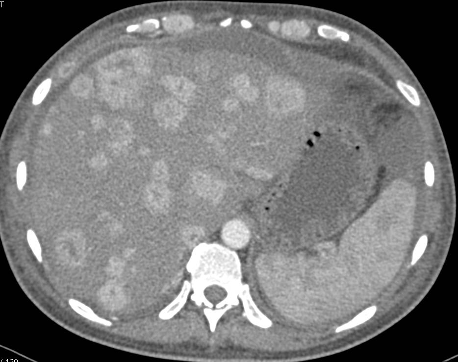 Metastatic Renal Cell Carcinoma to the Liver with Vascular Metastases - CTisus CT Scan