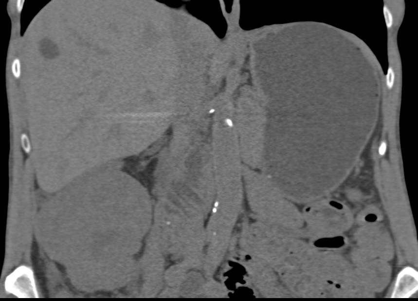 Beautiful 3D Imaging of a Renal Oncocytoma with the Central Scar - CTisus CT Scan