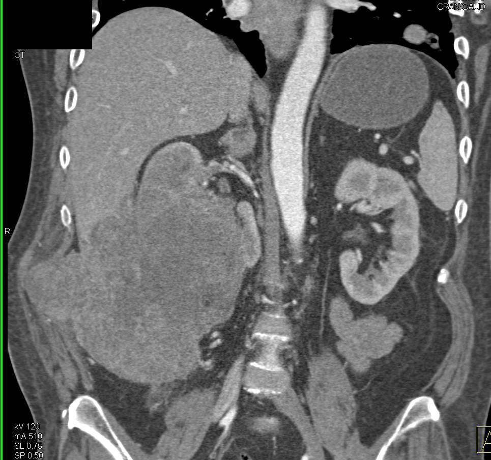 Stage IV Renal Cell Carcinoma Invading the Abdominal Wall - CTisus CT Scan