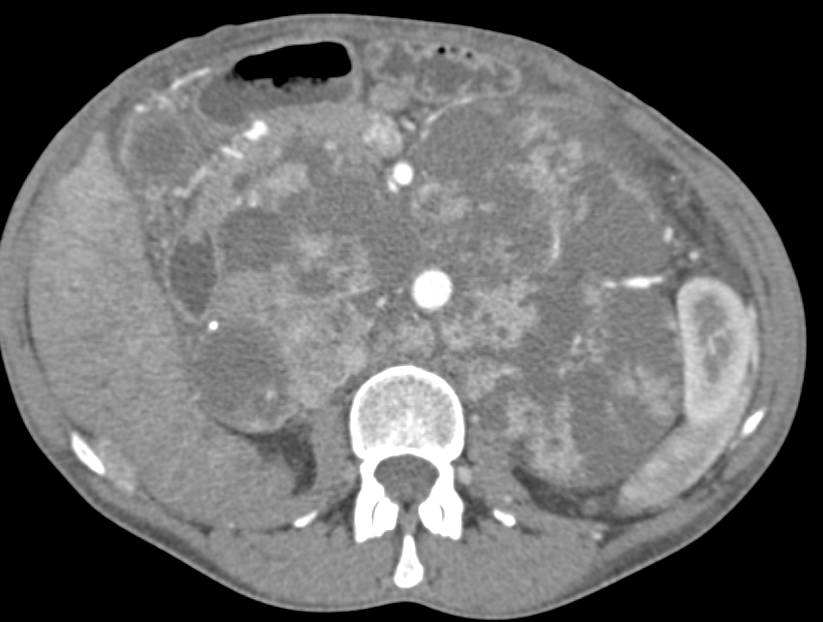 Incredible Example of Cystic Nodes from Recurrent Renal Cell Carcinoma - CTisus CT Scan