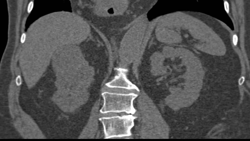 Renal Cell Carcinoma - CTisus CT Scan